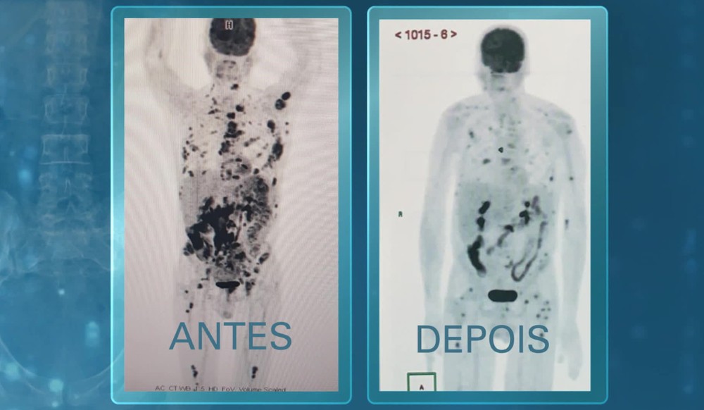 Técnica pioneira contra câncer vai estar no SUS? Saiba como 4 novos pacientes serão decisivos no estudo